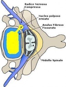 Anatomie der Bandscheibe mit Bandscheibenvorfall auf der rechten Seite, der auf die Nervenwurzel drückt, Wirbel, Rückenmark, Nerv, Gallertkern, Faserring, gespalten, gerissen.