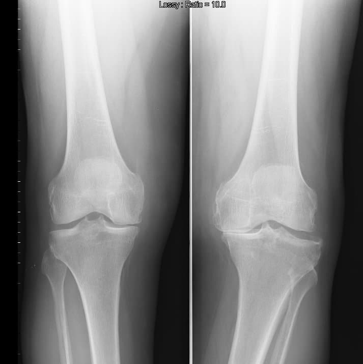 Röntgenbild, Knie, Arthrose, Stellung, unkorrekt, Knorpel, abgenutzt, verschlissen