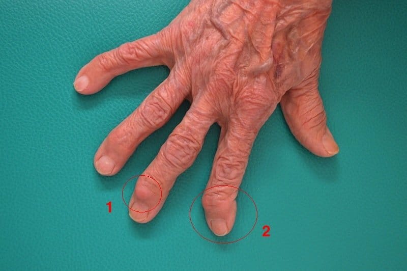 Arthrose,Finger,Hand,Knoten,Heberden,Schiefstand,letztes Fingerglied