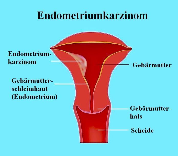 Gebärmutterkrebs,Endometriumkarzinom,Schmerzen,Therapie
