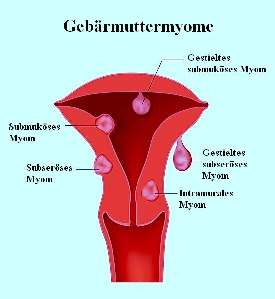  Gebärmutterfibrom,Gebärmutter,Bild,Bildung,Masse,Zellen,Neoplasie