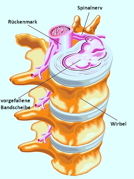 Anatomie der Bandscheibe mit rechtsseitigem Bandscheibenvorfall, der auf die Nervenwurzel drückt, Wirbel, Rückenmark, Nerv, Gallertkern, Nucleus pulposus, Fasserring, Anulus fibrosus, gespalten, gerissen