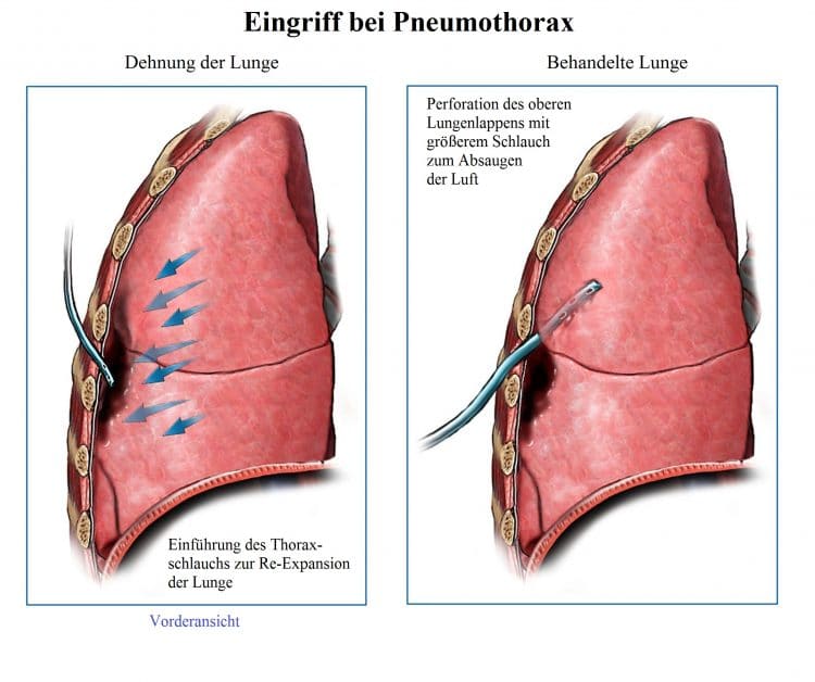 Pneumothorax, Drainage, Operation und Heilungsprozess, Therapie